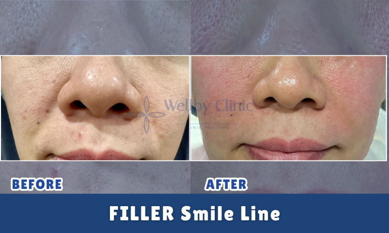 Filler Smile Line