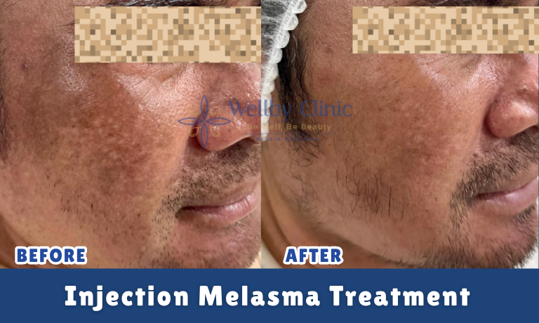 Injection Melasma Treatment