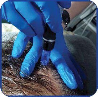 PRP Hair Growth Therapy