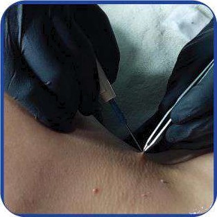 Wellby Electrocauter